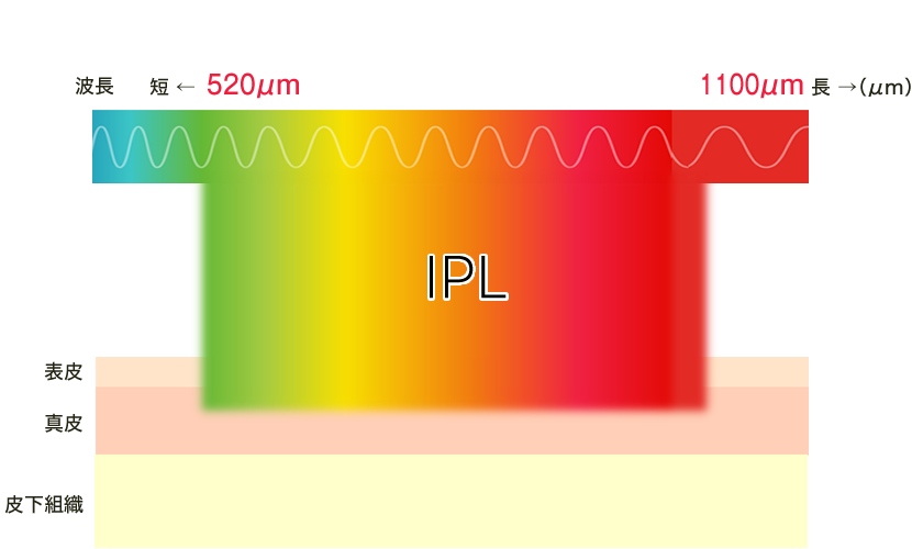 幅広いIPL(光)の波長について