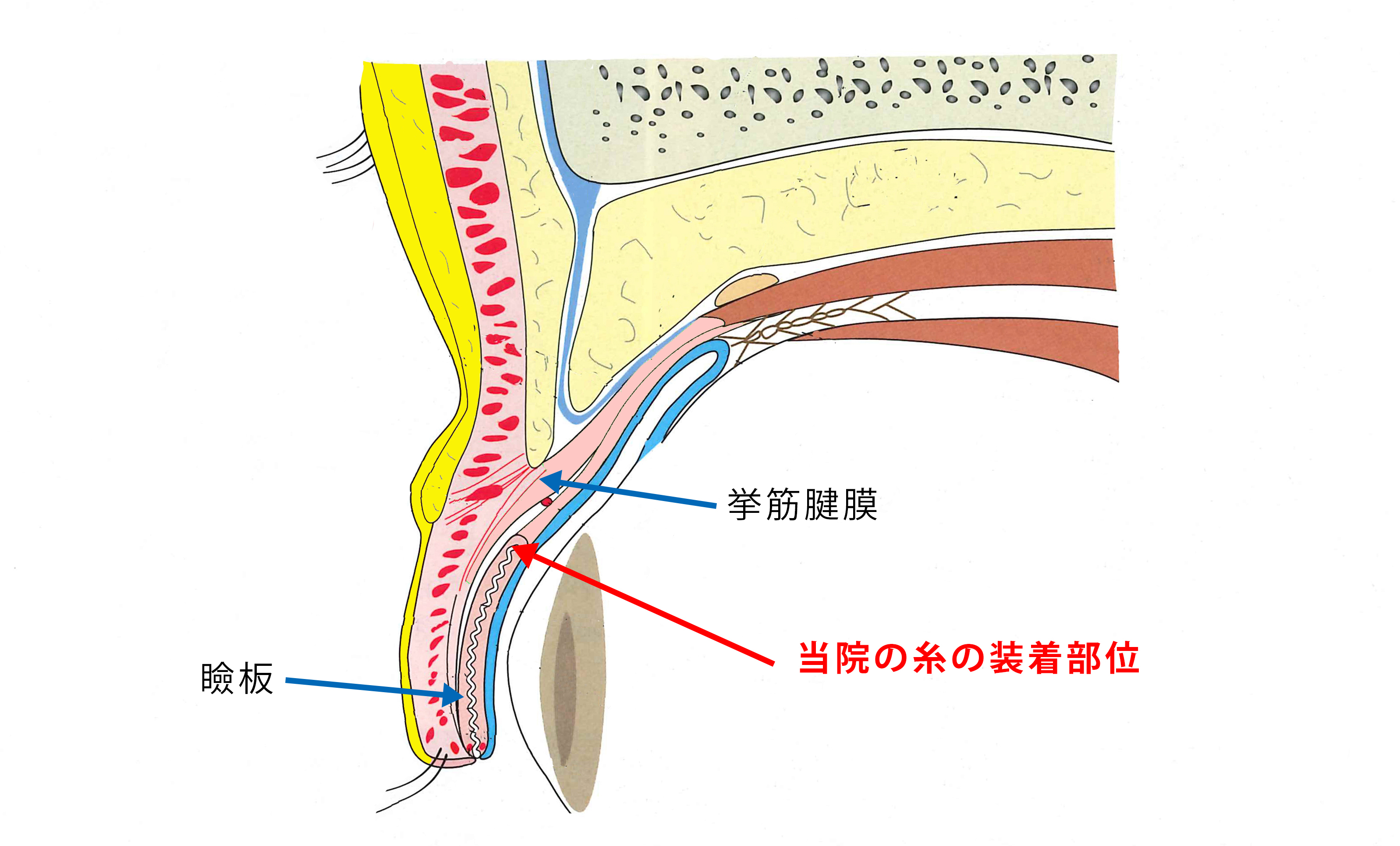 埋没法の糸を、瞼板上縁の挙筋腱膜の付着部位に固定