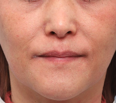 『皮剥け』開始から1週間後