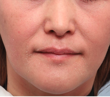 『反応期』開始から6週間後