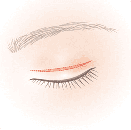 重瞼ラインから除皺するリフトアップ術