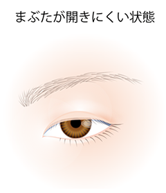 腱膜性眼瞼下垂症