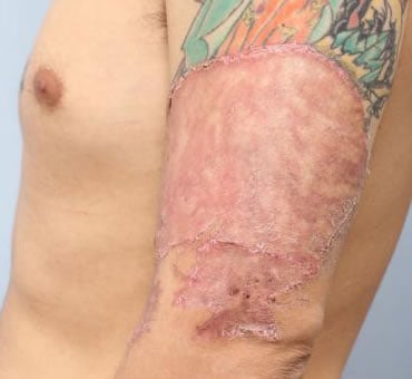 全層植皮術で刺青・タトゥー・tattooを消す - 刺青・タトゥー・tattooの除去・色素疾患 よだ形成外科クリニック