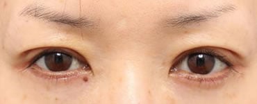 術後（7日抜糸直後）開眼
腫れは少ない方です。ハムラ法も行って下まぶたも改善しています。
