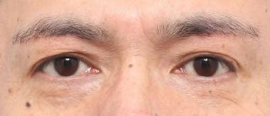 術後（6ヶ月）開眼
眉毛の位置がやや変化するため
右側はやや再発傾向がありますが、良好です。