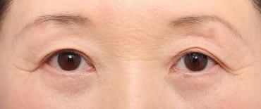 術後（3ヶ月）開眼
傷はさらに改善します。