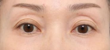 術後（3ヶ月）開眼
皮膚の質感の向上と小ジワの減少が認められます。