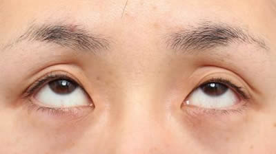 術前　開眼　上方視
黒目下の白目の範囲が大きくなります。