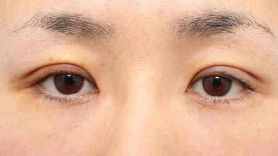 術後（1週間）開眼
腫れは普通の方でしょう。
