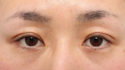 術後（2ヶ月）開眼
まだ腫れはあります。
左右差や開眼量はこの後も改善していきます。