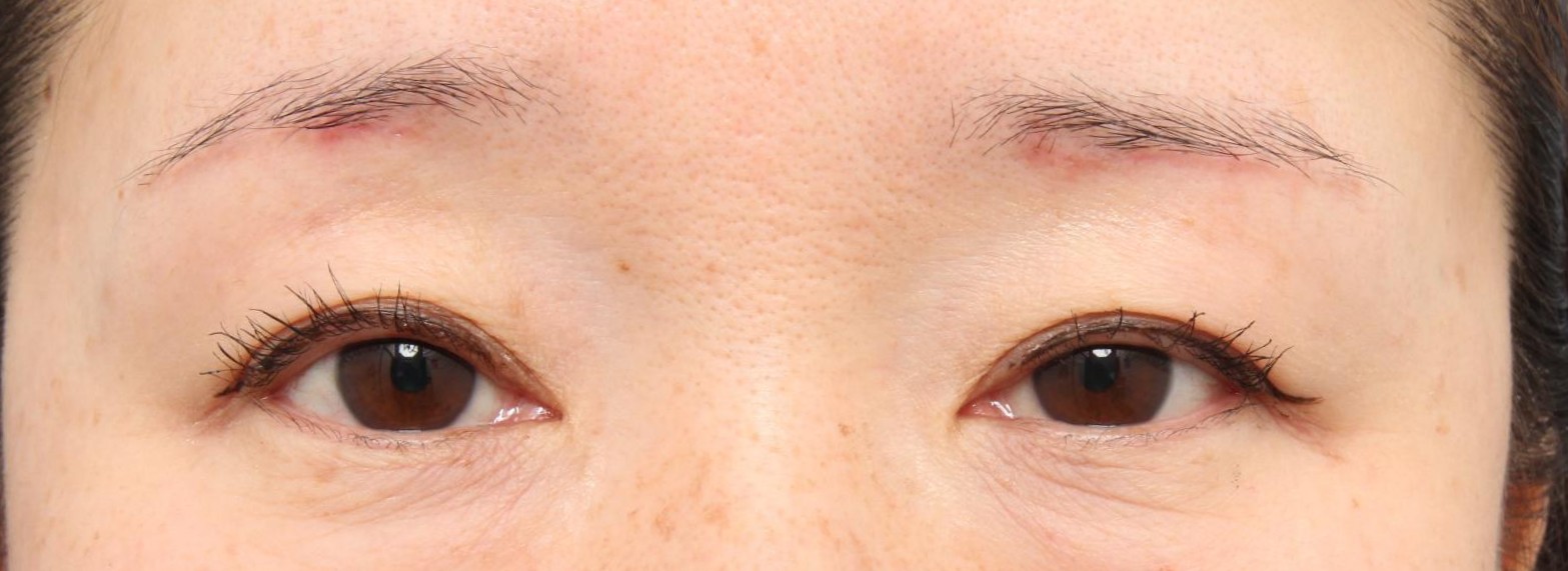 術後5ヶ月　開眼