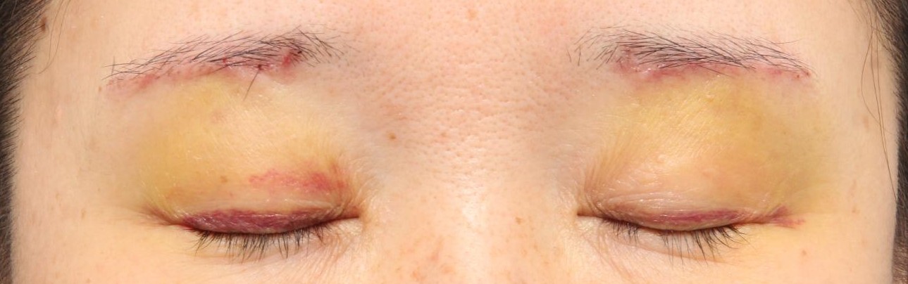 術後1週間　閉眼