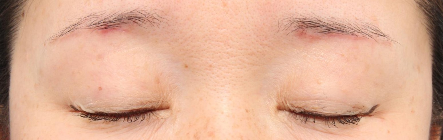 術後5ヶ月　閉眼