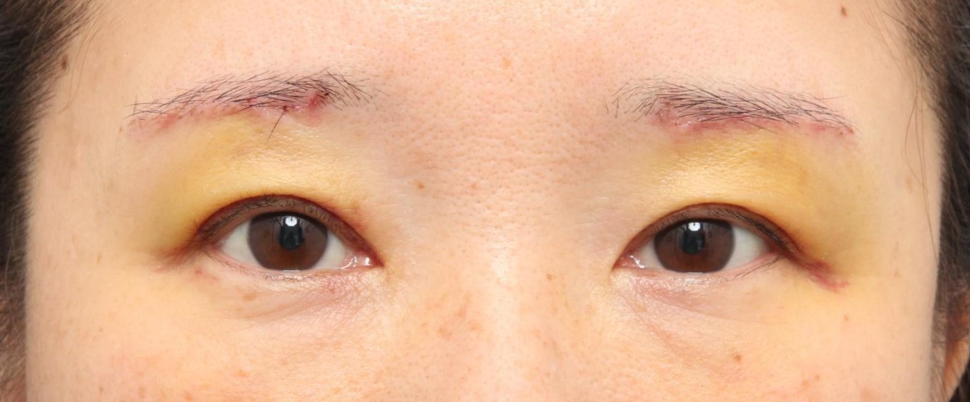 術後1週間　開眼